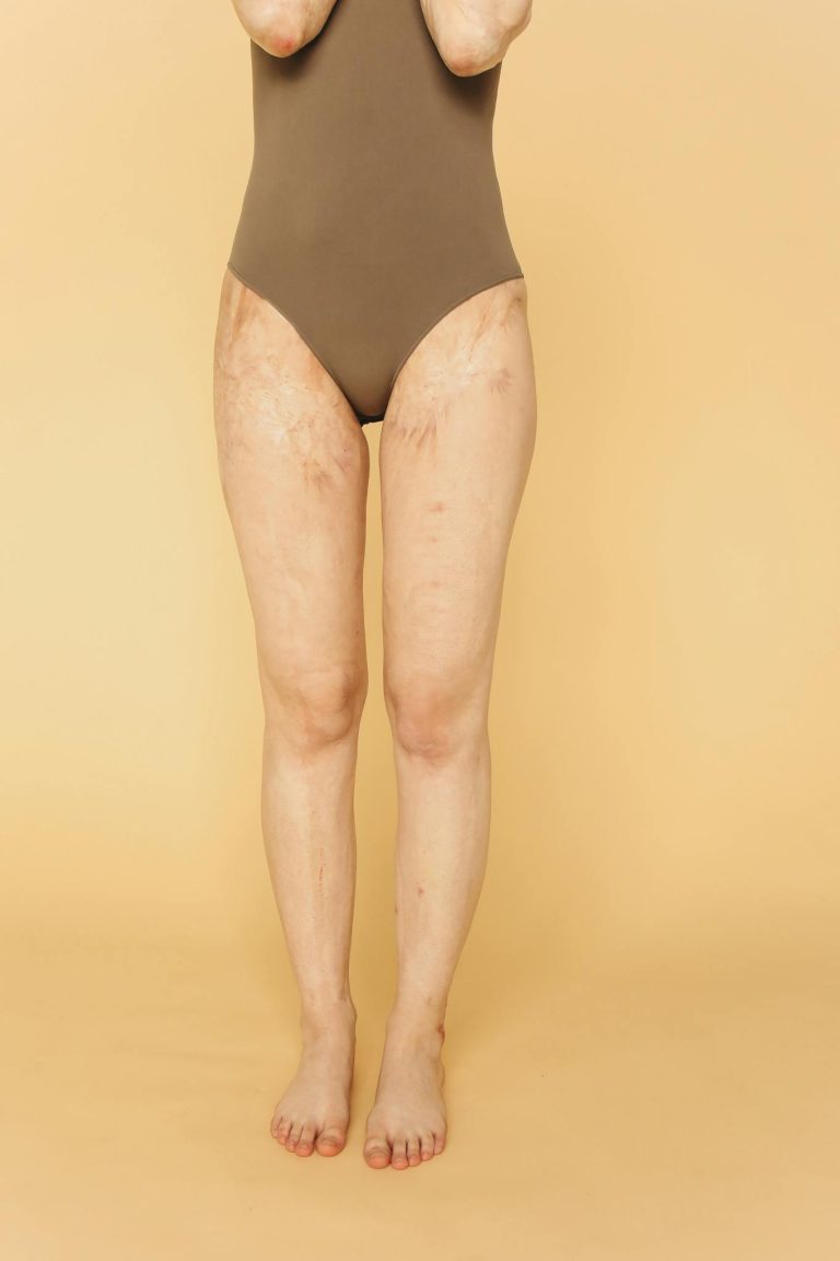 A woman standing barefoot in a brown bodysuit showcases her resilient scars against a beige background.